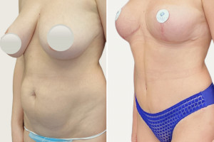 Подтяжка груди без имплантов + абдоминопластика с липосакцией